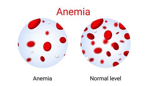 TIBC (Transferrin and Total Iron Binding Capacity) | Pathology Tests Explained