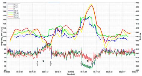 Investigation of Cerebral Autoregulation Using Time-Frequency ...
