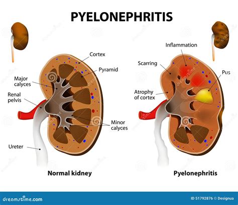 pielonefritis: acute pyelonephritis – TJTO