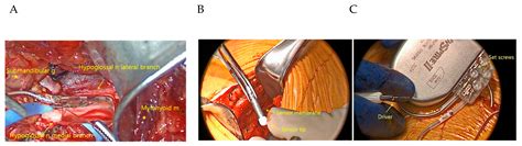 Obstructive Sleep Apnea: Emerging Treatments Targeting the Genioglossus ...