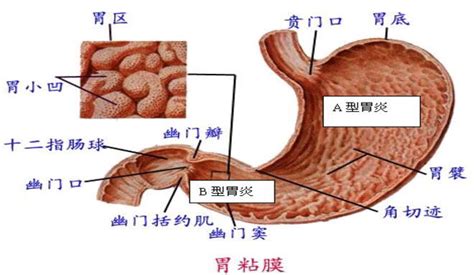 慢性胃炎的症状图片,慢性胃炎图片大全_慢性胃炎_39疾病百科