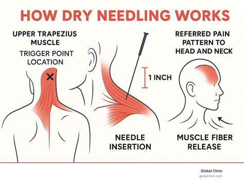 Does Dry Needling Hurt