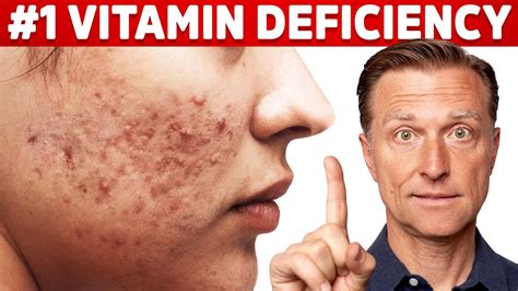 Vitamin D deficiency in adults is called:Question 21 options:A) osteoporosisB) osteomalaciaC) hypercalcemiaD) hypocalcemia