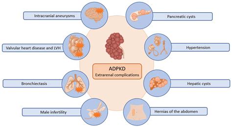 Polycystic Kidney Syndrome