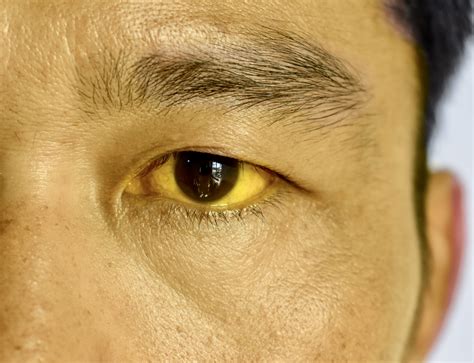 Scleral Icterus (Yellow Eyes): Causes, Symptoms & Treatment