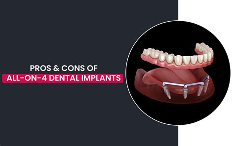 Pros and Cons of All on 4 Dental Implants- Explained Briefly