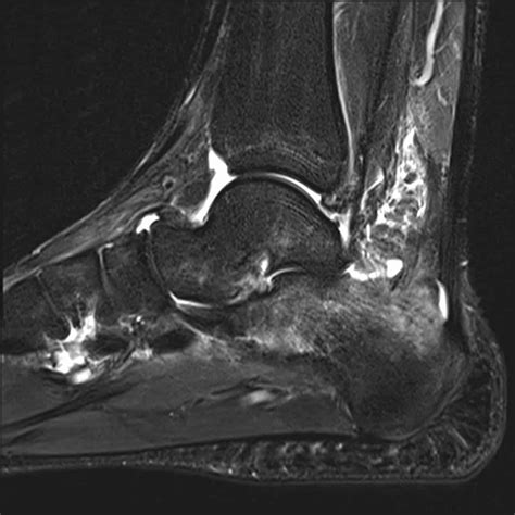 Lady Windermere Syndrome - Radiology features and differtial diagnosis