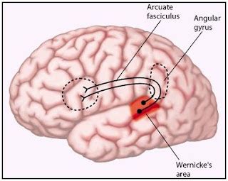 Image result for Conduction Aphasia