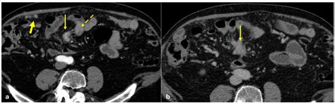 The Many Faces of the Angry Peritoneum