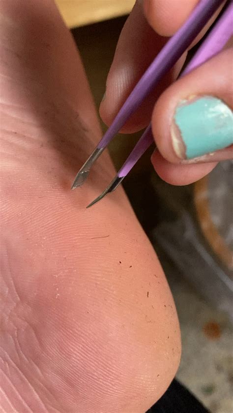 Image result for Hair Splinter Infection