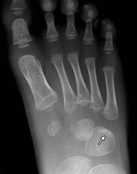 Acute Fractures and Dislocations of the Ankle and Foot in Children | RadioGraphics