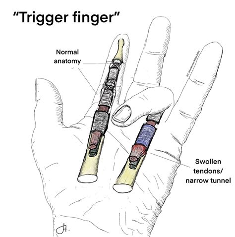 Trigger finger - James Henderson - Specialist Plastic & Hand Surgeon