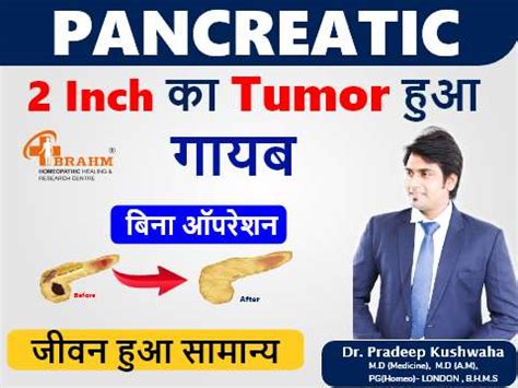 Pancreatic tumor kese thik kare ? | अग्न्याशय ट्यूमर | Pancreatic Tumor ...