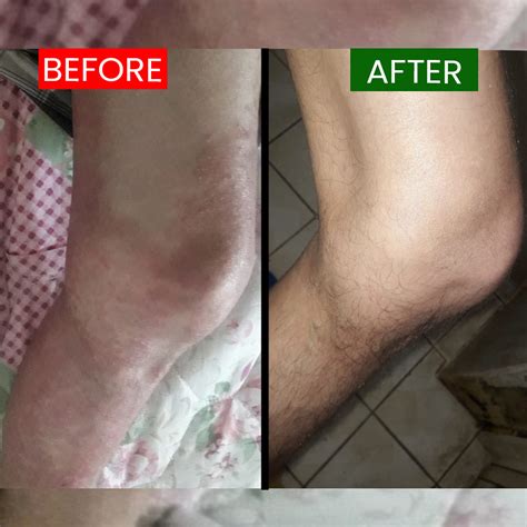 Psoriasis Form Submission