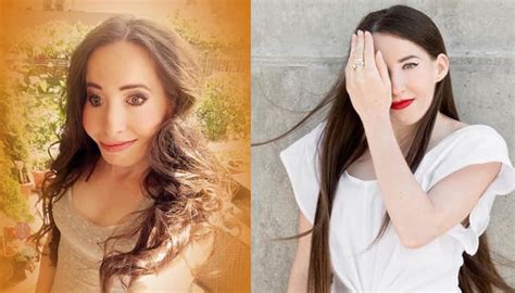 This 30-year-old woman was bullied over her 'half face'! | Health News ...