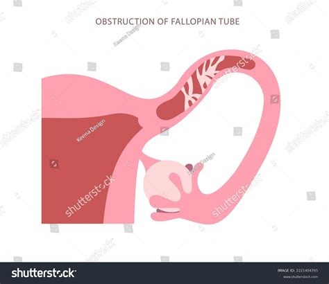 Image result for Fallopian Tube Surgery