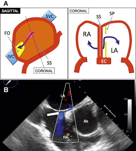 Imaging of atrial septal defects: echocardiography and CT correlation ...