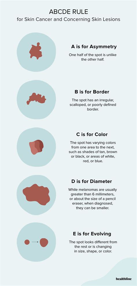 Abcde For Cancer at Kristie Cummings blog