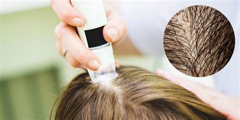 Hair and Scalp Analysis with Reseed Natural Hair Loss and Scalp Care ...