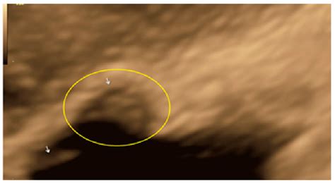 Superficial Endometriosis at Ultrasound Examination—A Diagnostic ...