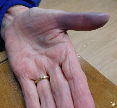 Bruised Middle Finger