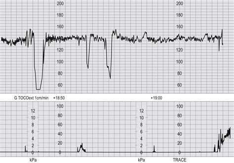 Fetal Asphyxia - Clinical Tree
