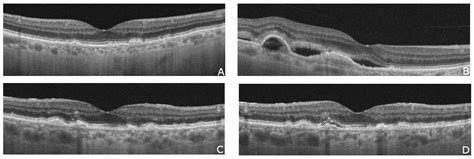 Early Optical Coherence Tomography Biomarkers for Selected Retinal ...