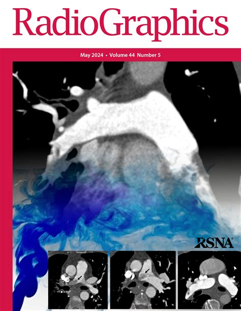 Adrenal Vein Sampling: Tips and Tricks | RadioGraphics