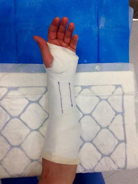 Hand Plaster 的图像结果