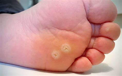 5 Skin Infections You Can Pick Up At The Gym And How To Prevent Them ...