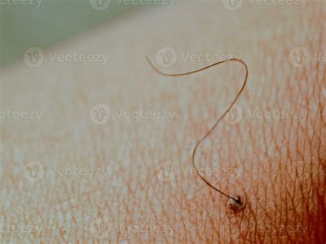Mole birthmark nevus macro photo on human skin with hair. close up ...
