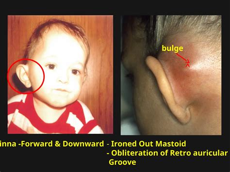 Acute Suppurative Otitis Media and acute mastoiditis KK.ppt