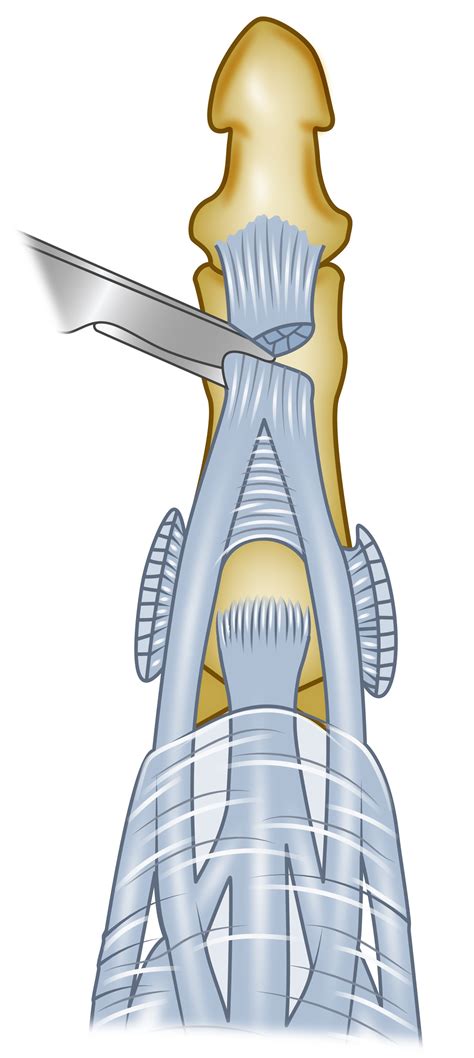 Managing Swan Neck and Boutonniere Deformities - Clinics in Plastic Surgery