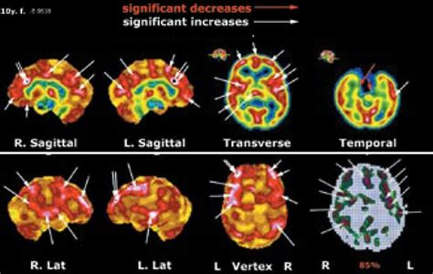 Image result for SPECT Scan Brain Prefrontal Cortex