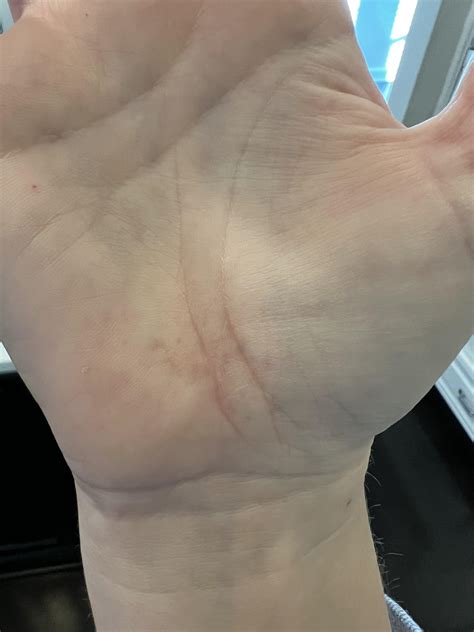Anyone else get bruised palms if you don’t use a mat for all floor work? : r/Purebarre