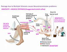 Image result for spasticity