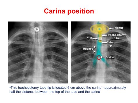 CHEST XRAY TUBES.pptx,,,,,,,,,,,,,,,,,,, | PPTX