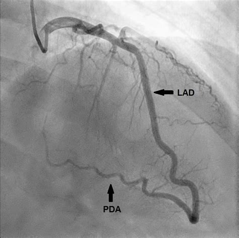 Rare Coronary Anomaly of Posterior Descending Artery Arising from ...