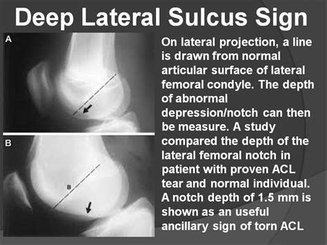 Sulcus Sign Explained 的图像结果
