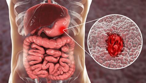 Understanding Causes, Symptoms, and Treatment of Gut Inflammation ...