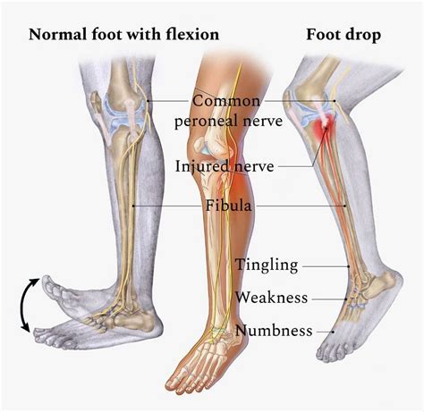 Peroneal Nerve Injury: EP's Chiropractic Team