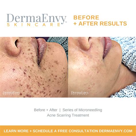 VAMP Facial Salmon DNA Microneedling Treatment | Discover Youthful Skin ...