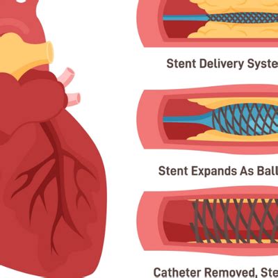 What Happens During an Angioplasty & Stent Procedure — A Patient’s ...