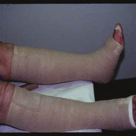 Image result for Show Compression Bandaging