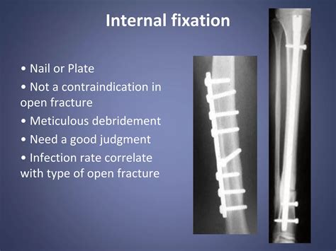 Image result for Open Fracture Surgery