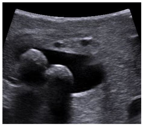 Choledocholithiasis Ultrasound