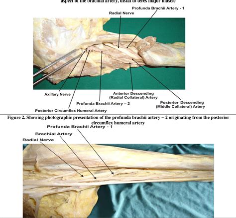 Figure 2 from A CASE REPORT ON DOUBLE PROFUNDA BRACHII ARTERIES OBSERVED DURING ROUTINE ...
