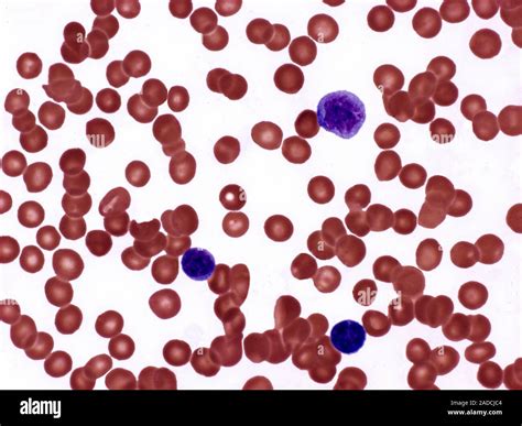 Polycythemia vera. Light micrograph of a blood smear from a patient with polycythemia vera ...