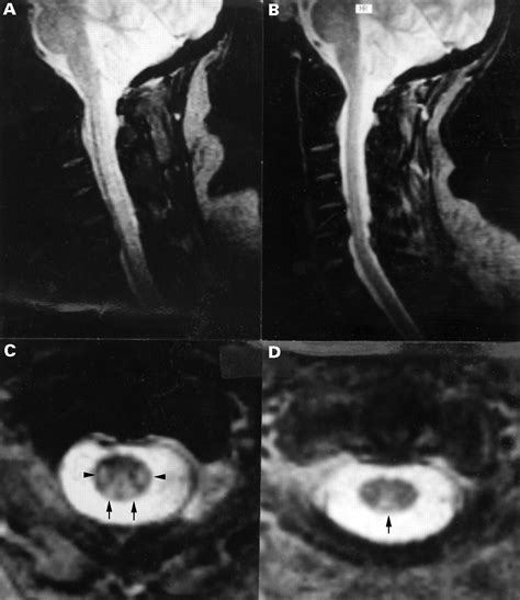 Subacute Combined Degeneration