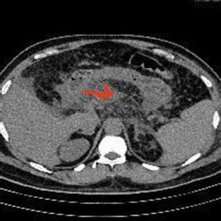 Image result for CT Scan with Contrast